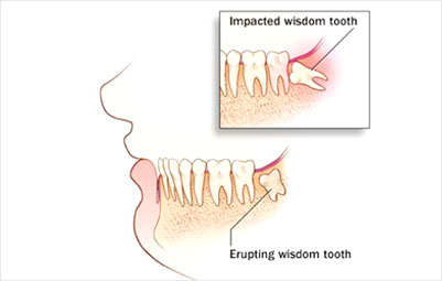 tooth removal